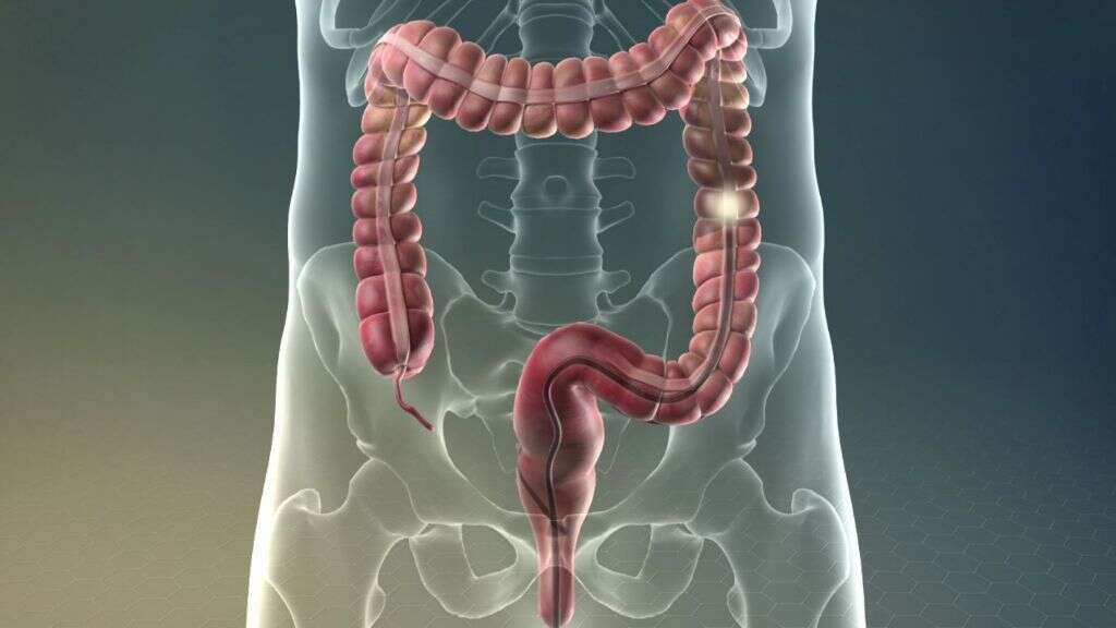 Inflammation