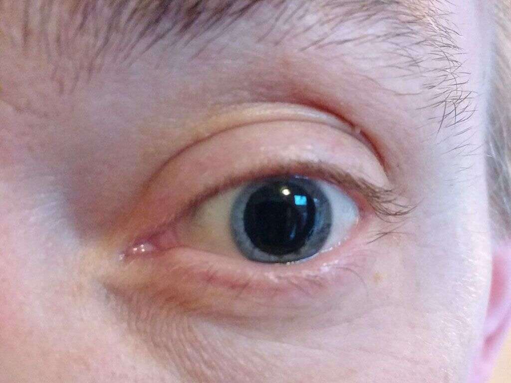 3 Natural Remedies For Eye Irritation