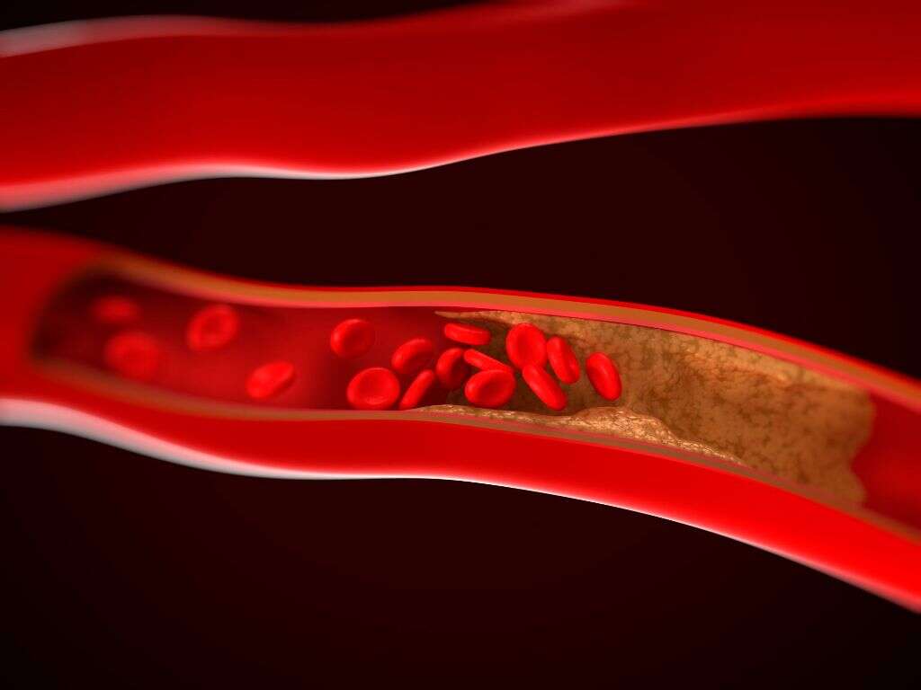 Ischemia