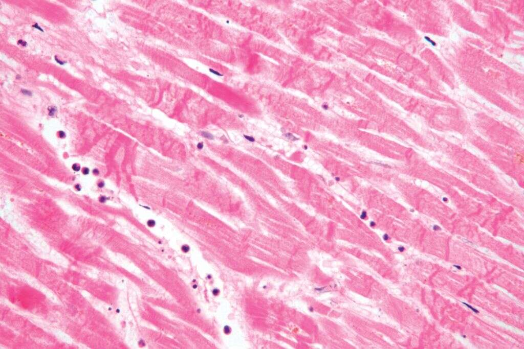 Ischemia