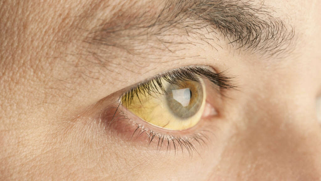 Jaundice