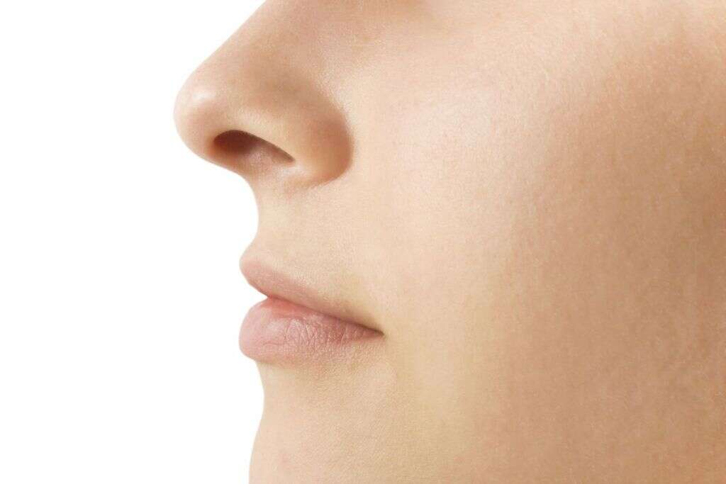 Kallmann Syndrome