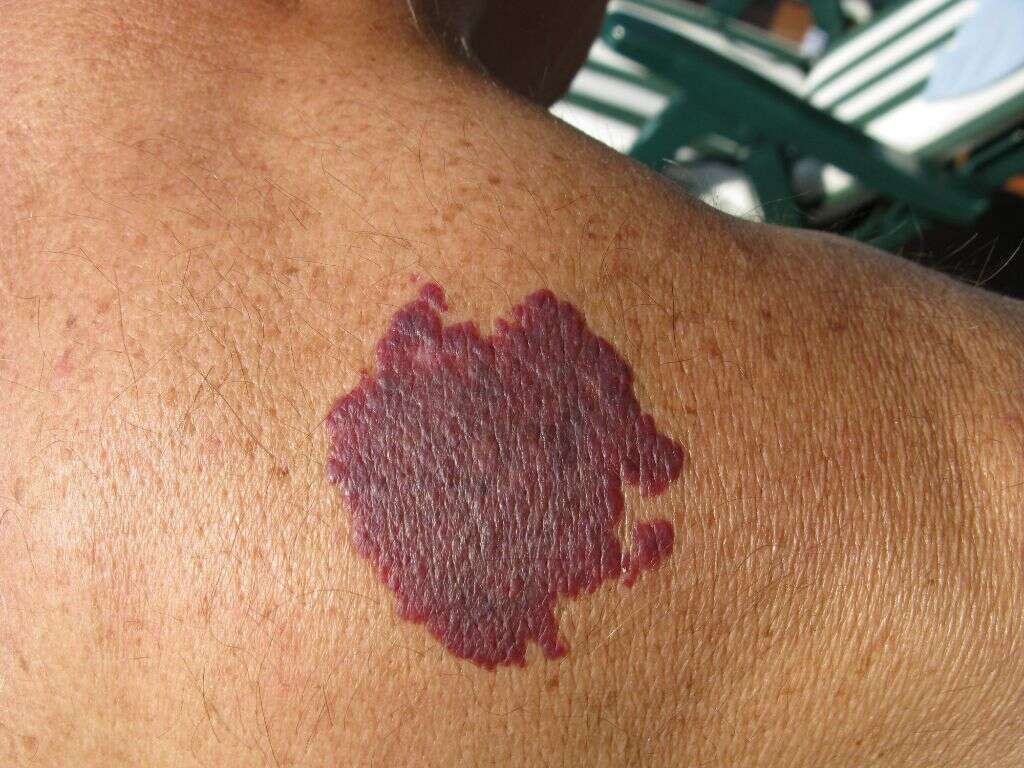 Klippel Trenaunay Syndrome