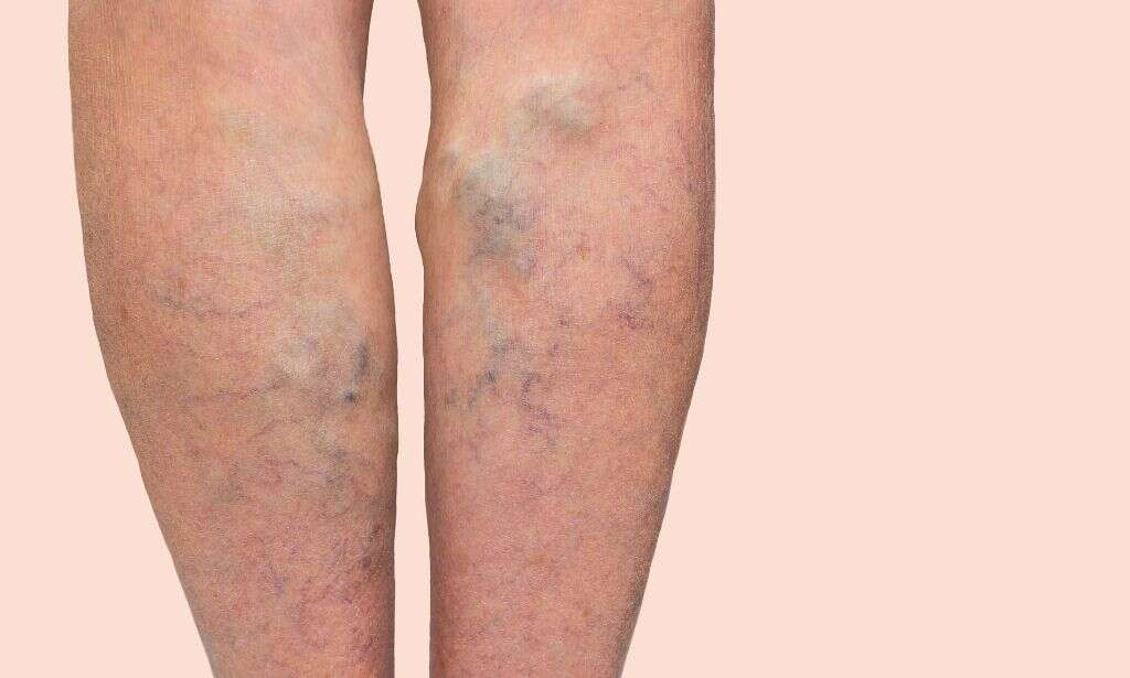 Klippel Trenaunay Syndrome