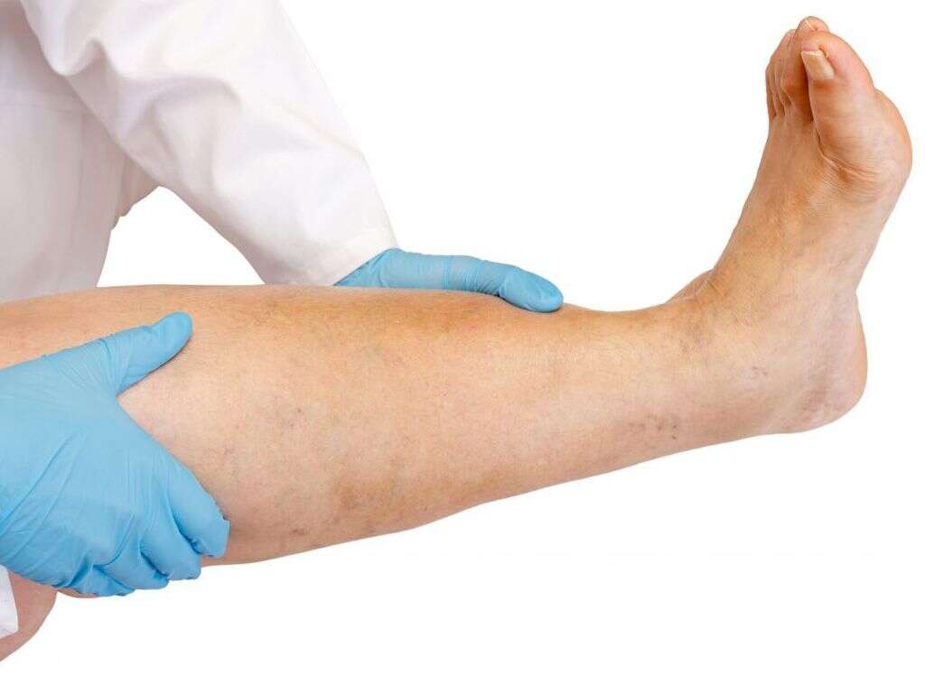 Klippel Trenaunay Syndrome