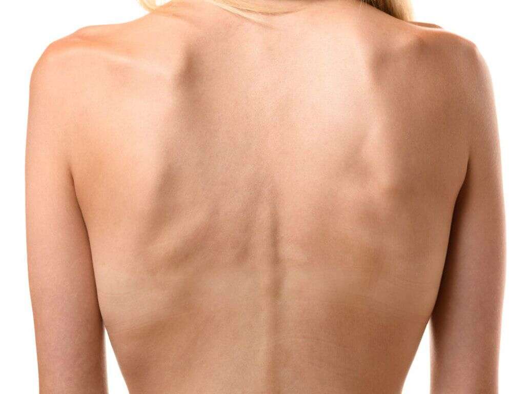 Kwashiorkor