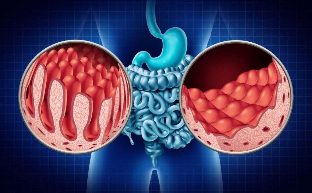 Leaky Gut Syndrome