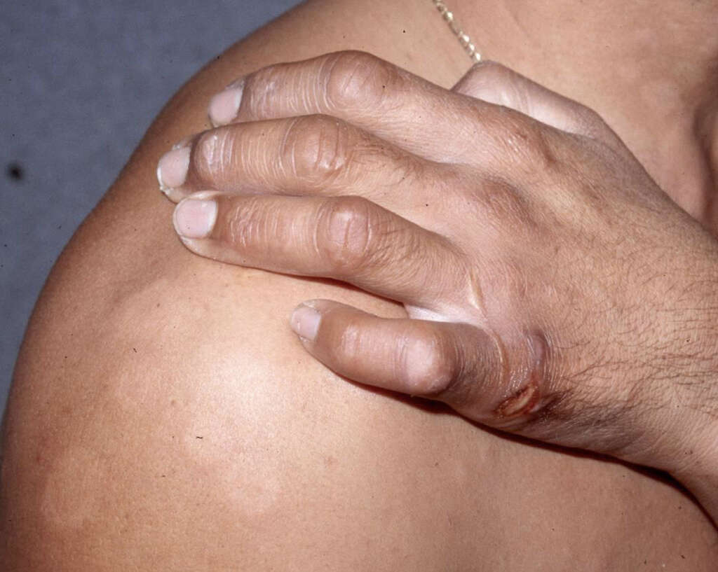 Leprosy