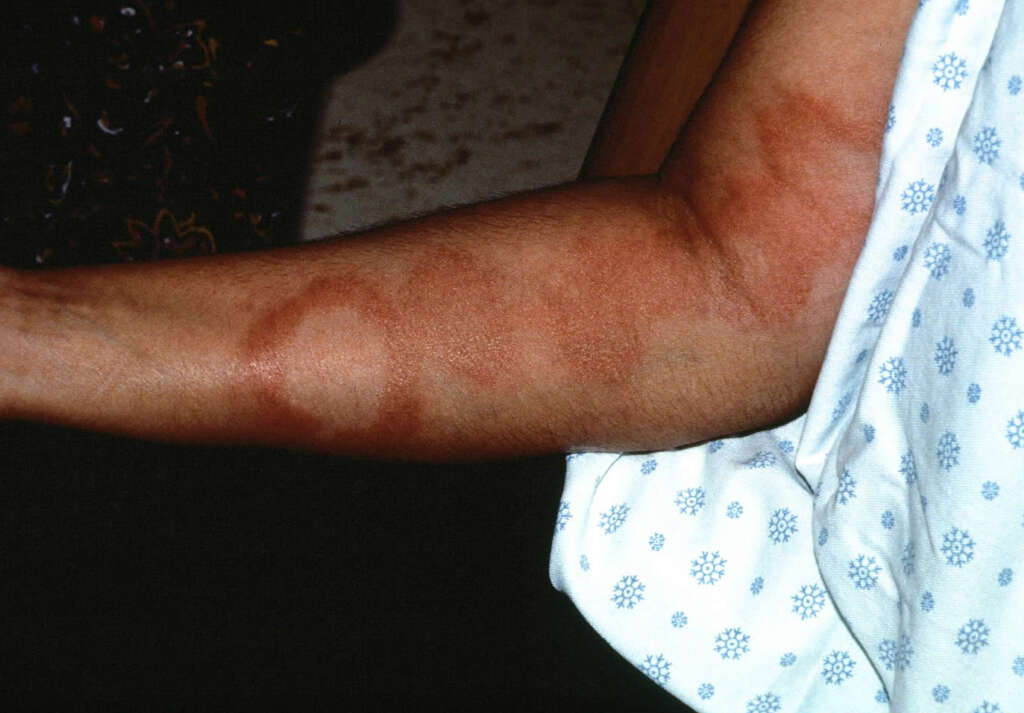 Leprosy