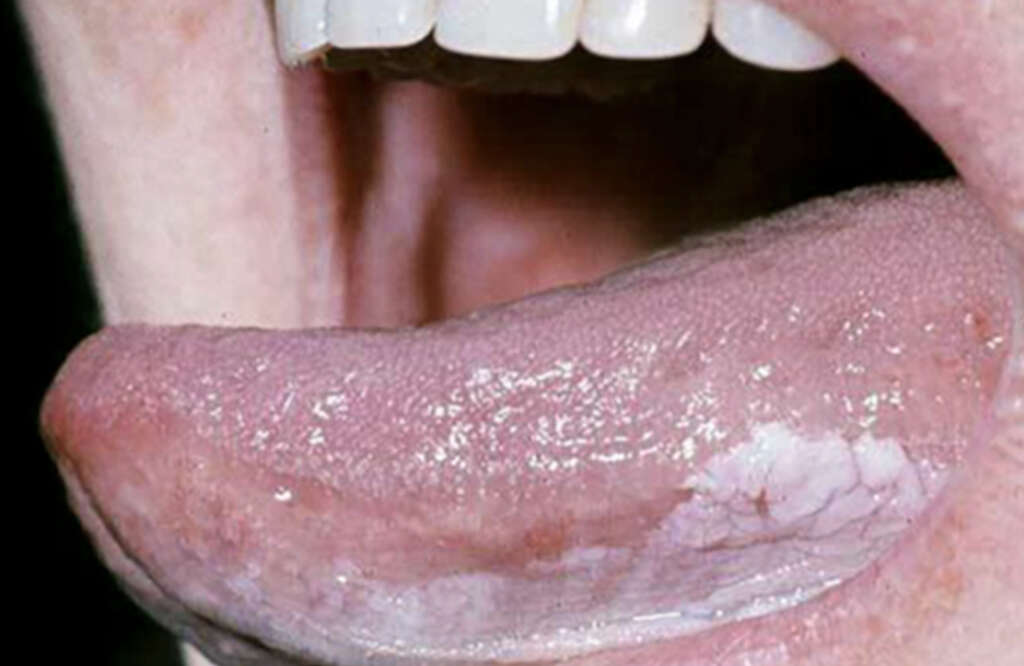 Leukoplakia