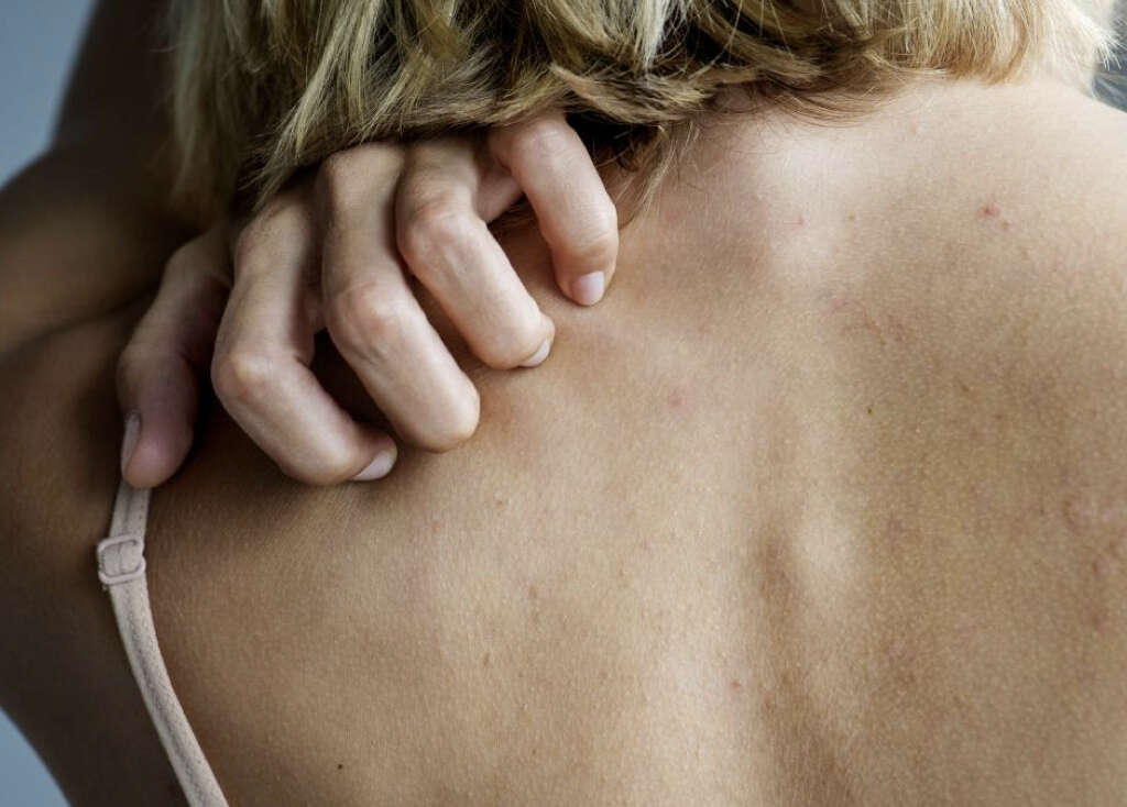 Lichen Planus