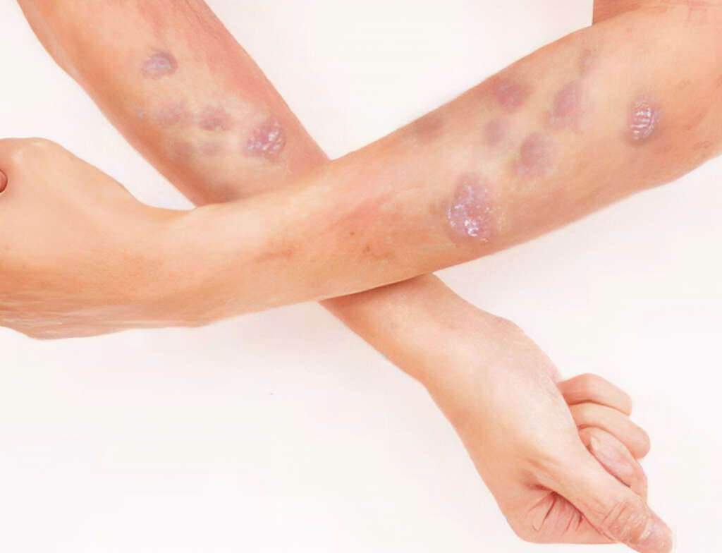 Lichen Planus