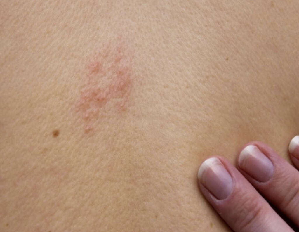 Lichen Planus