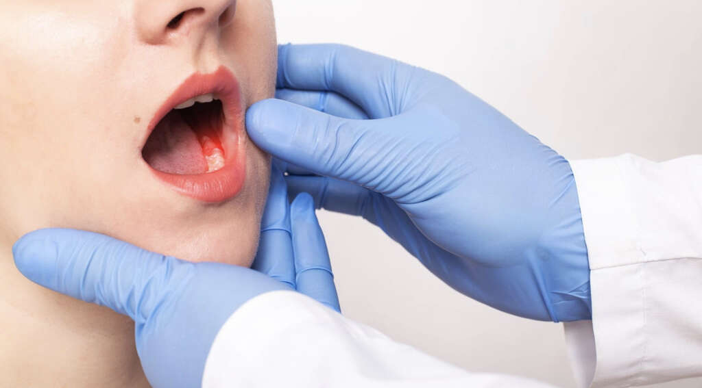 Lichen Planus