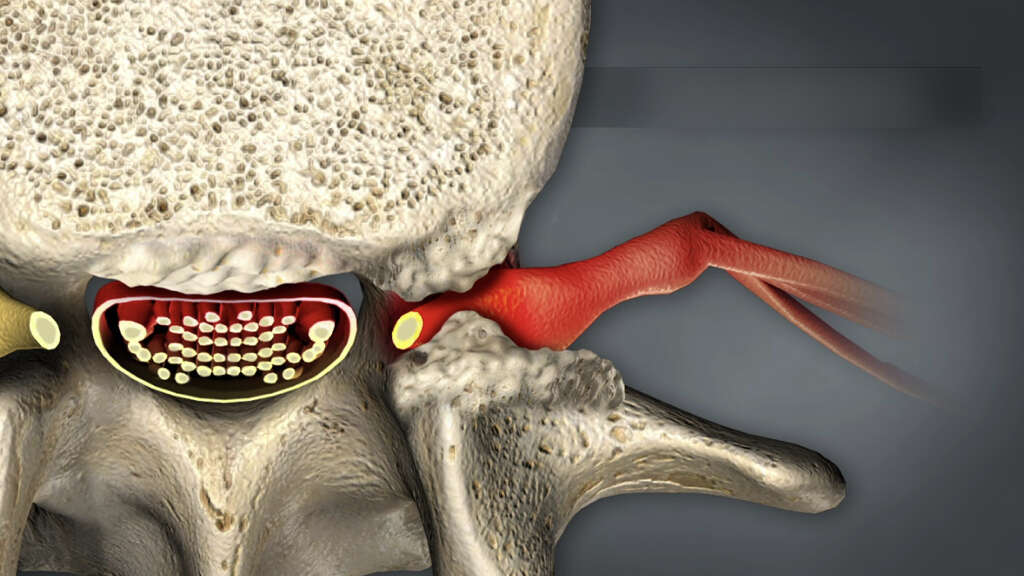 Lumbar Spinal Stenosis