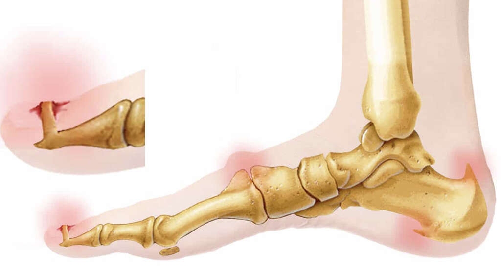 Lumbar Spinal Stenosis