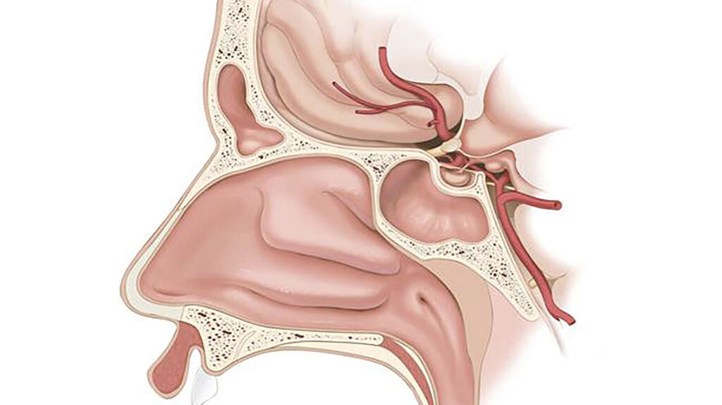 Lumbar Spinal Stenosis