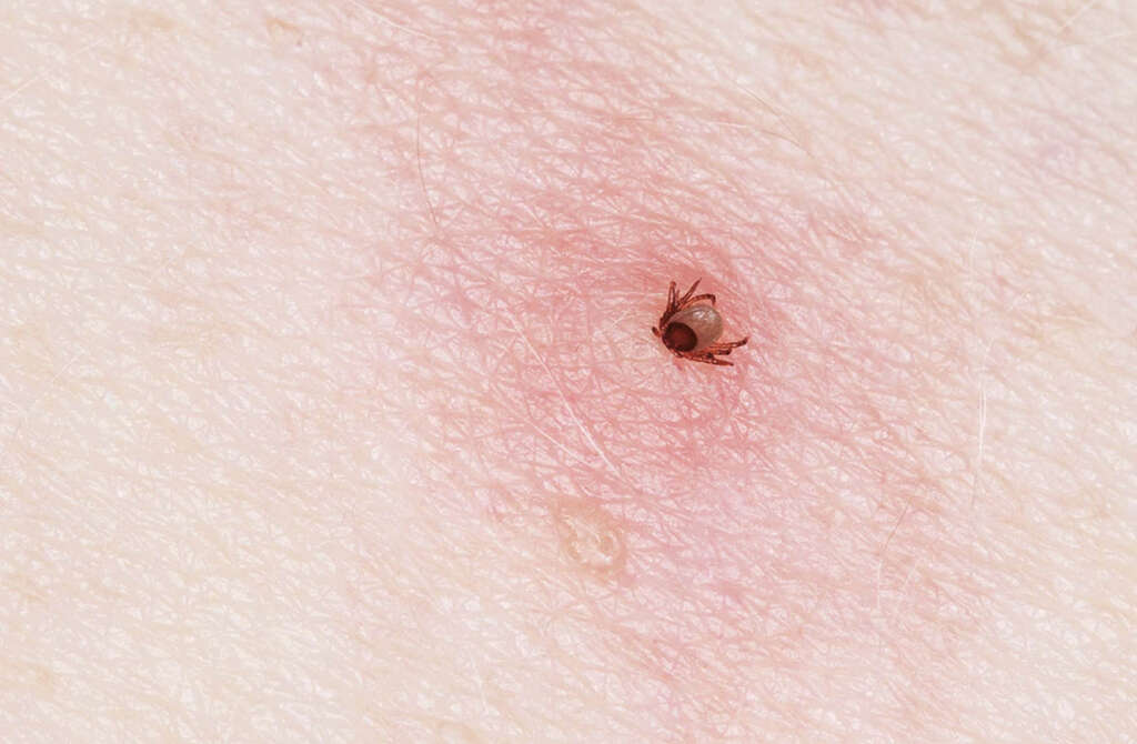 Lyme Disease