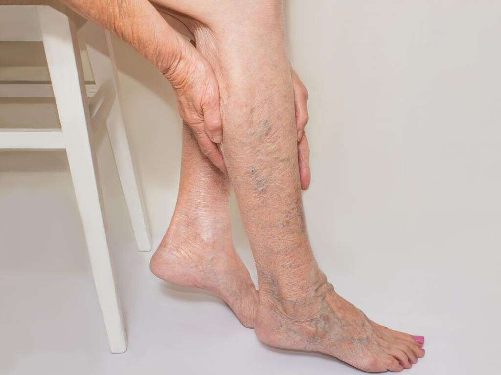 Lympedema