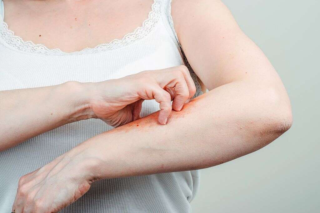 Lymphangitis