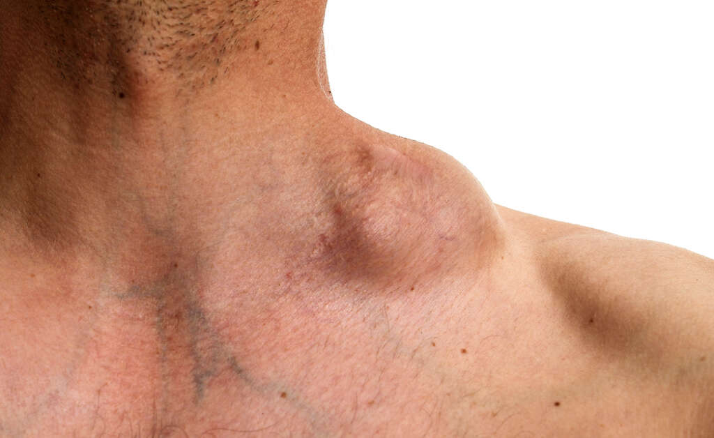 Lymphoma