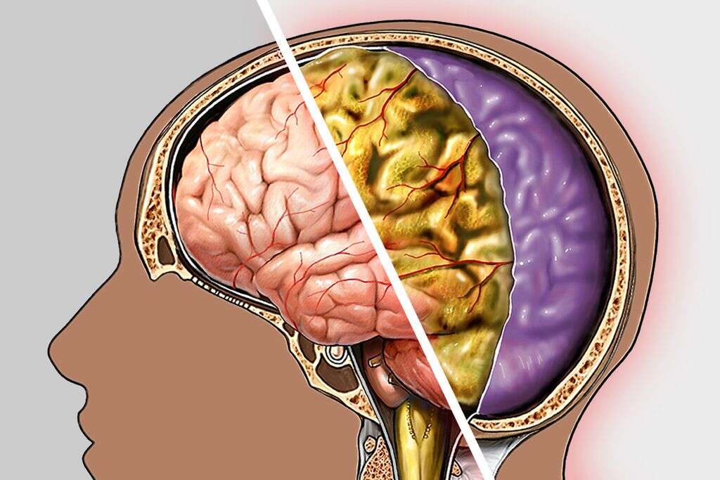 Meningitis