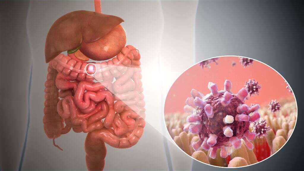 Mesenteric Adenitis