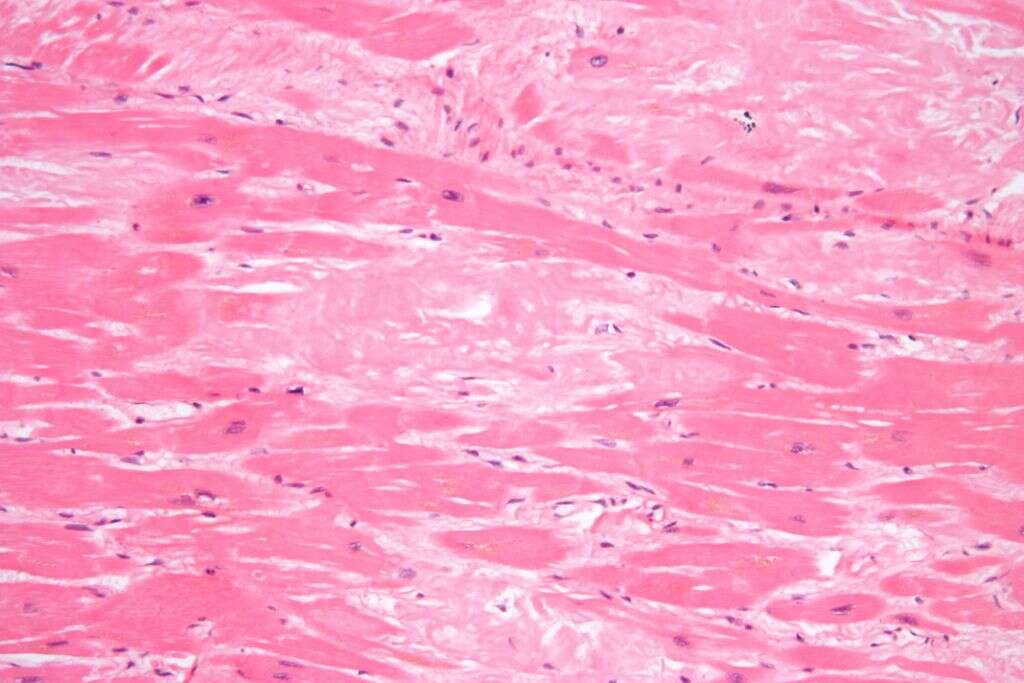 MGUS