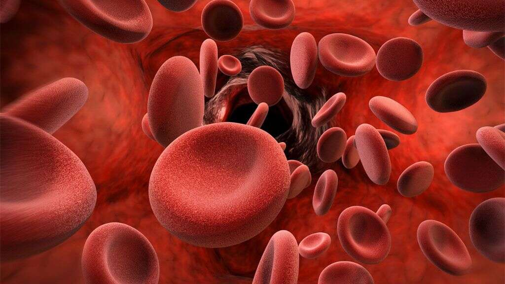 Microcytic Anemia