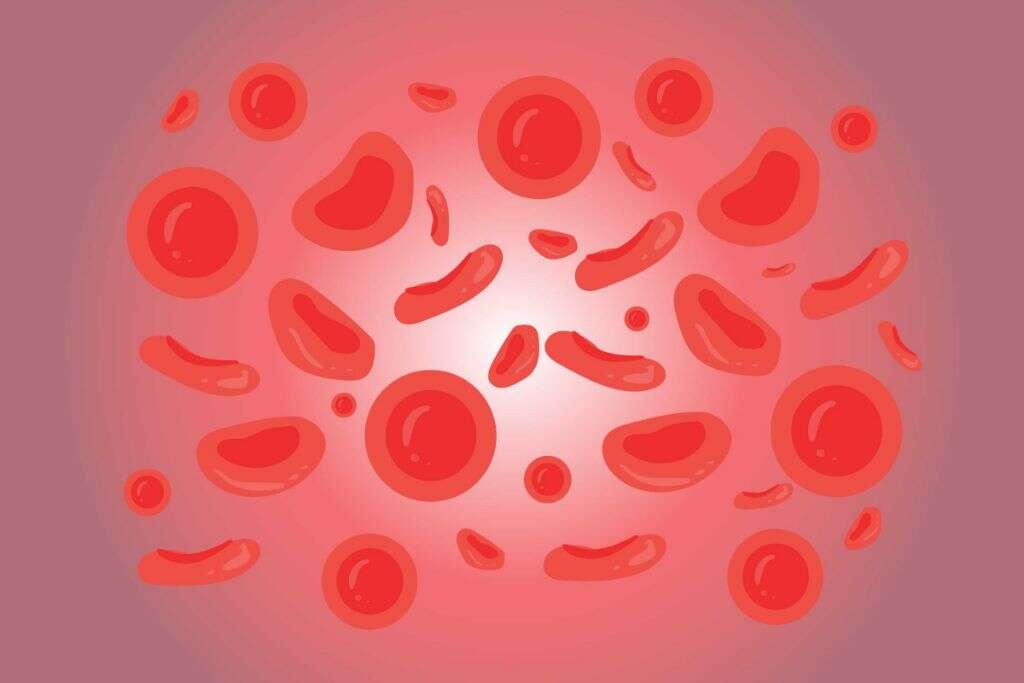 Microcytic Anemia