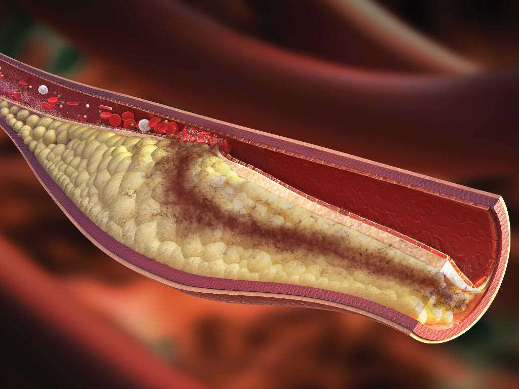 Mixed Hyperlipidemia