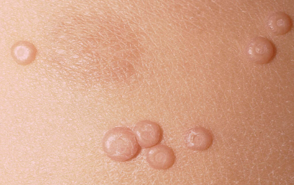 Molluscum Contagiosum