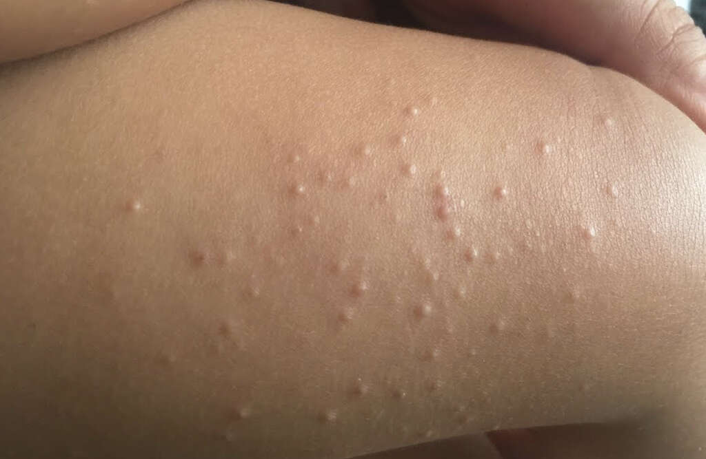 Molluscum Contagiosum