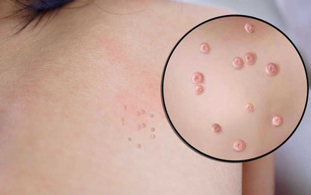 Molluscum Contagiosum