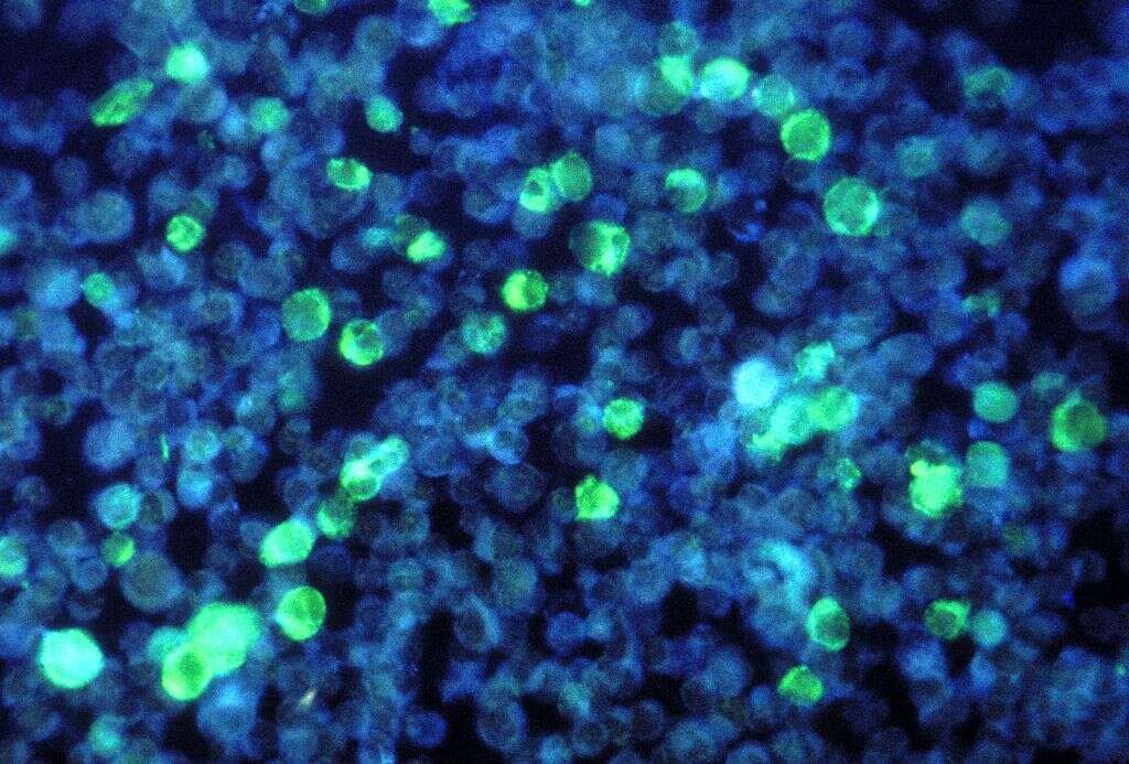 Mononucleosis
