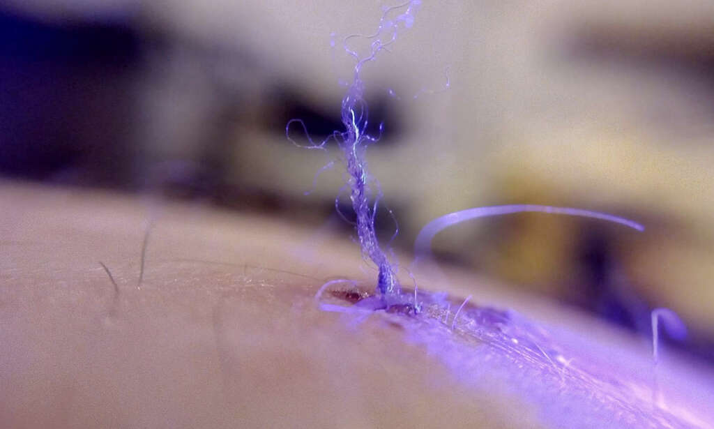 Morgellons
