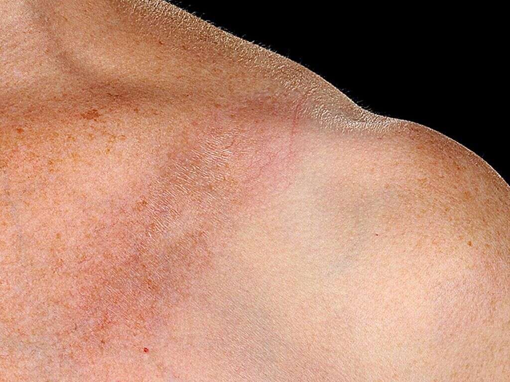 Morphea