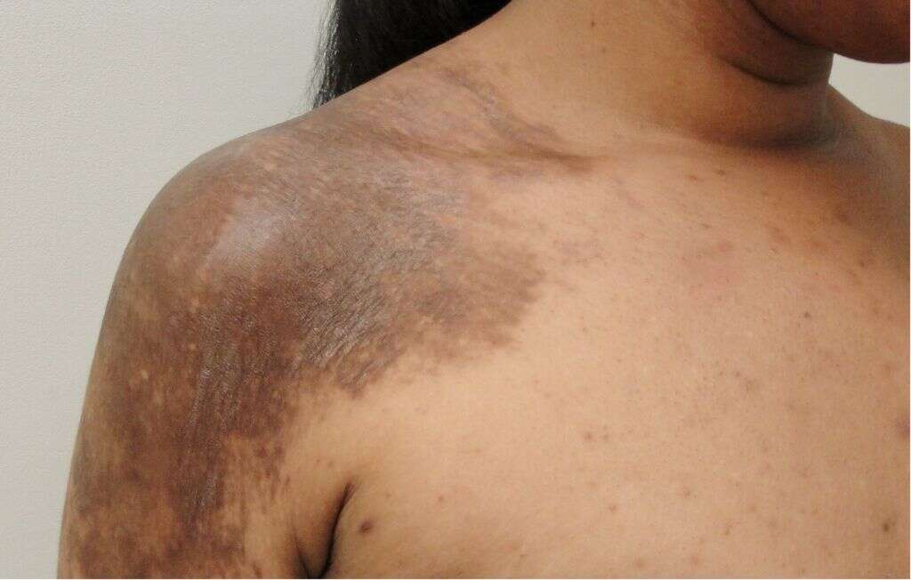 Morphea