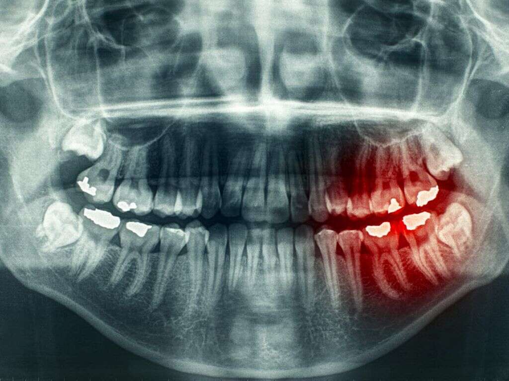 Mouth Cancer