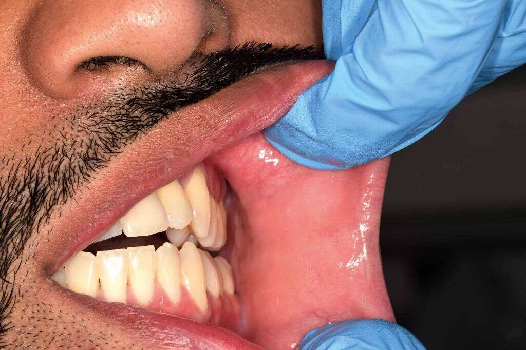 Mouth Cancer