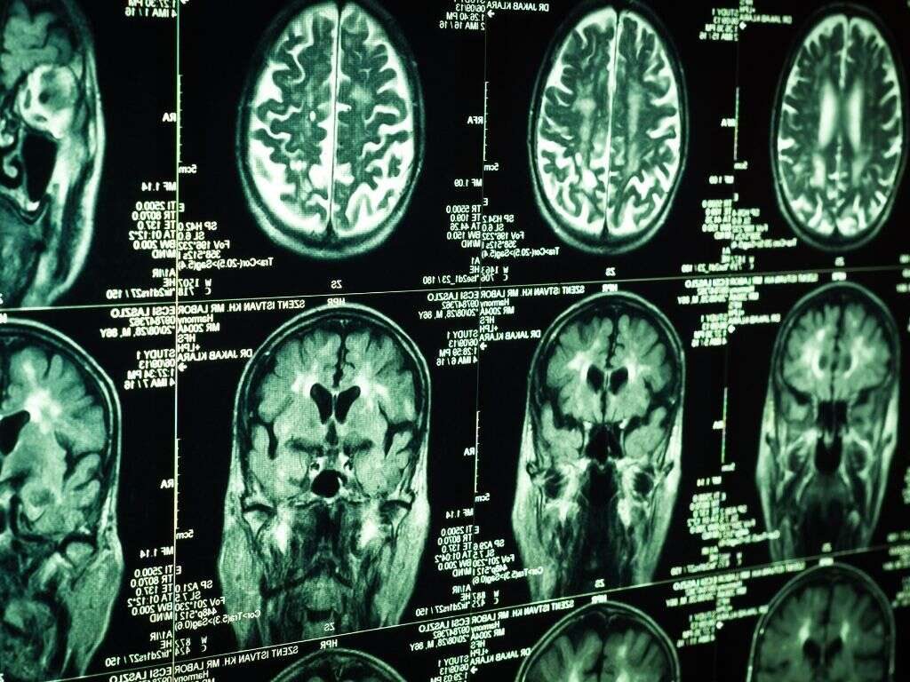 Moyamoya Disease