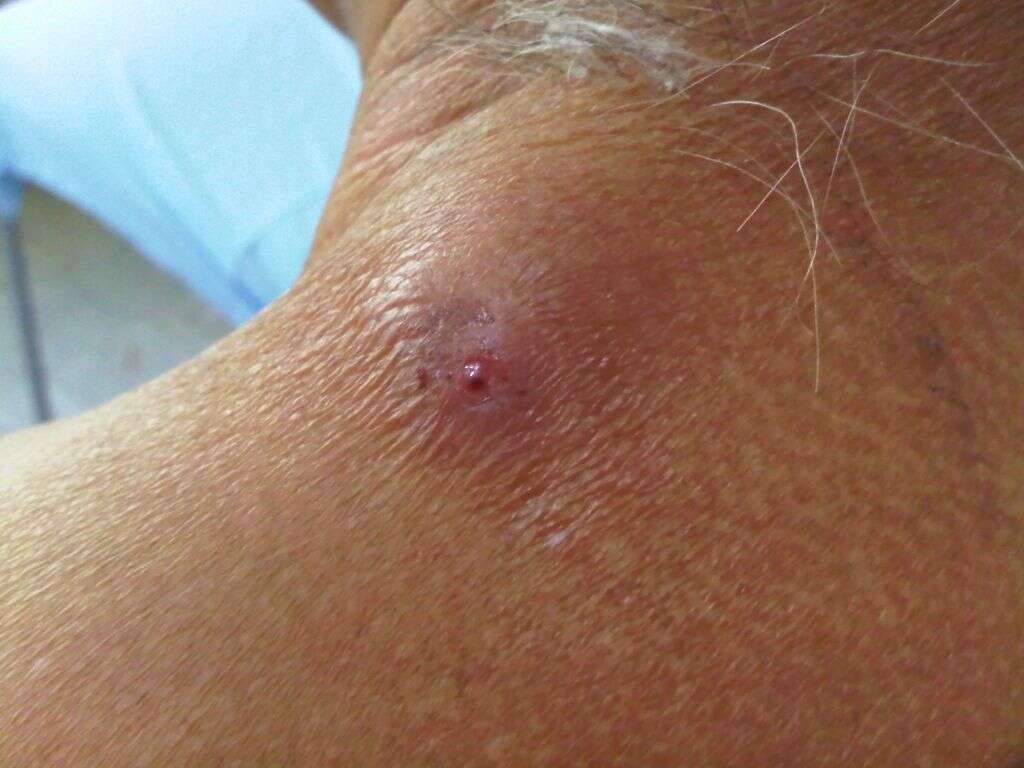 Myiasis