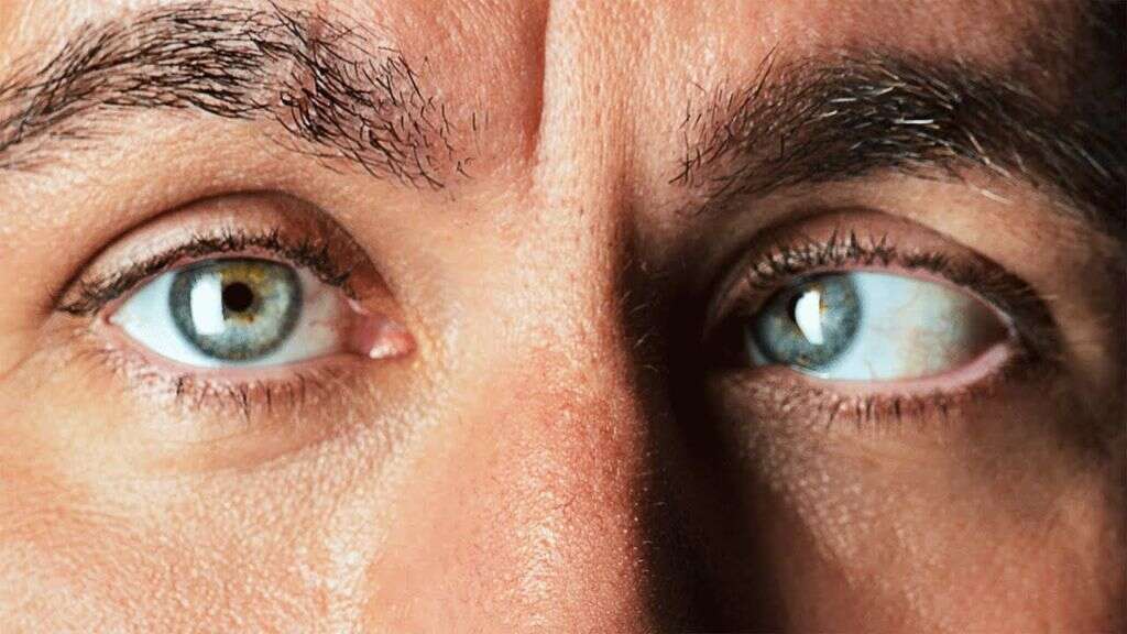 Myopia