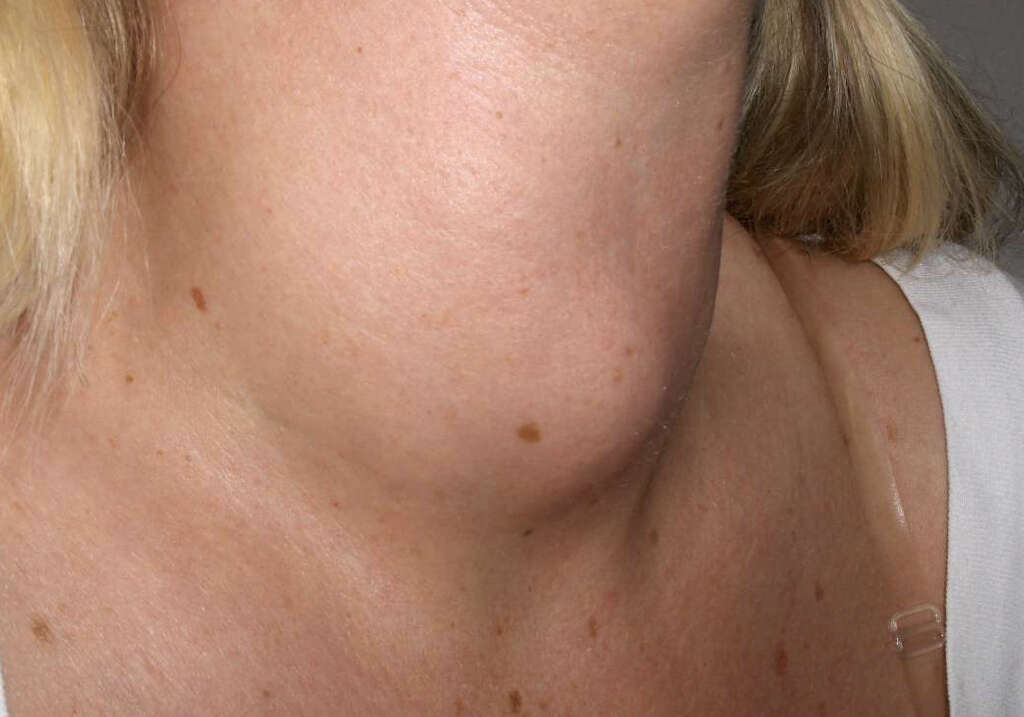 Myxedema