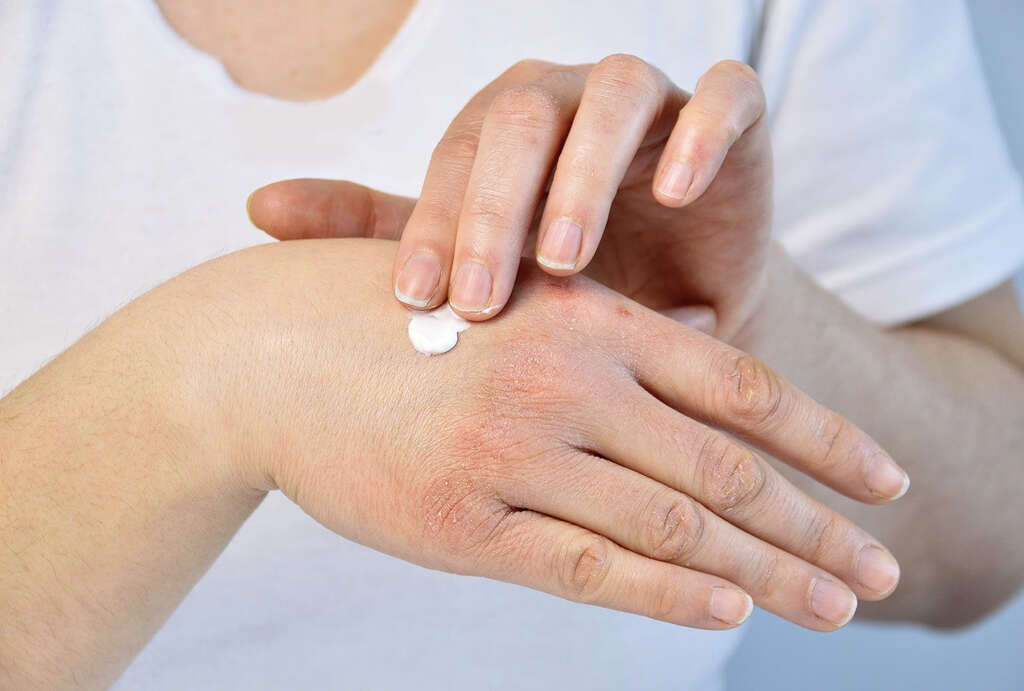 Myxedema