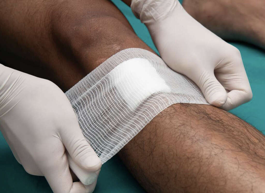 Necrotizing Fasciitis