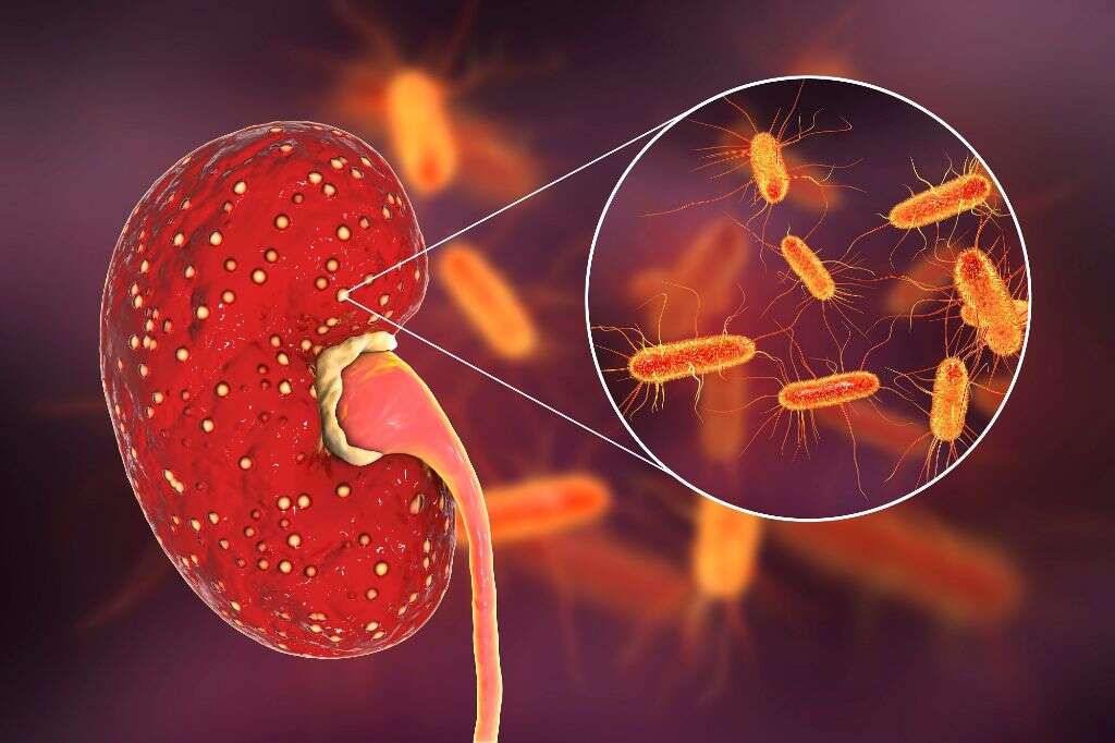 Nephritis