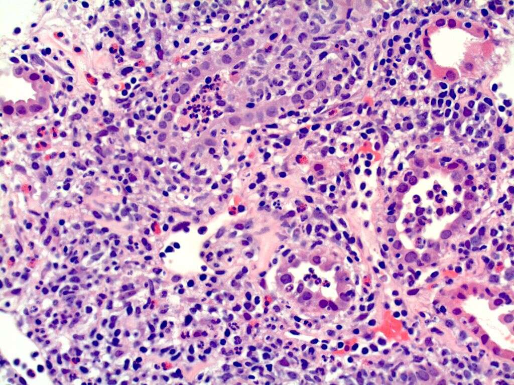 Nephritis