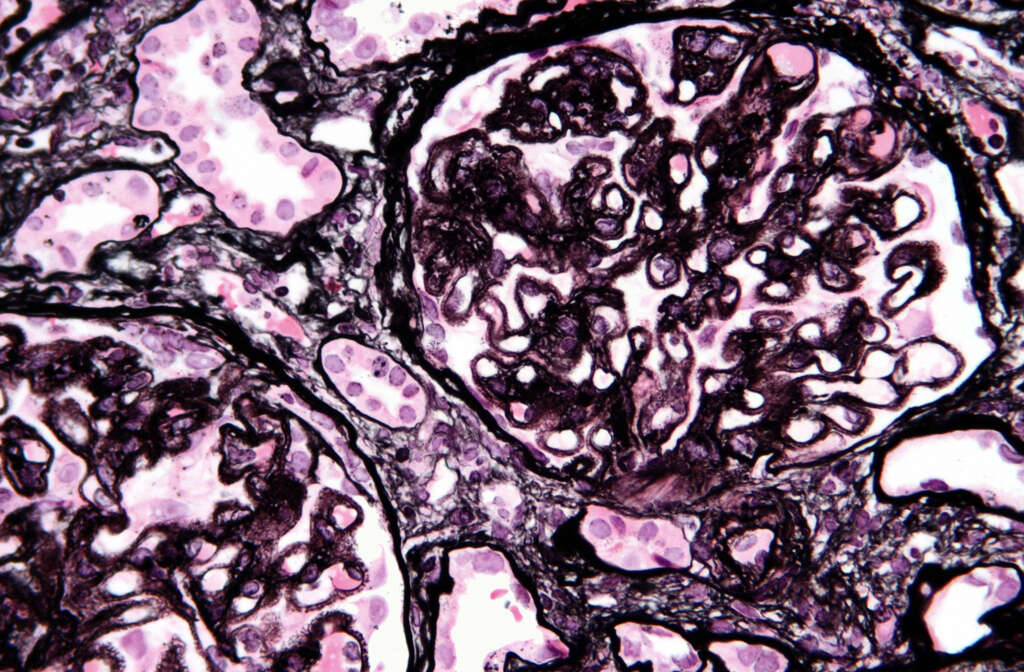 Nephrotic Syndrome