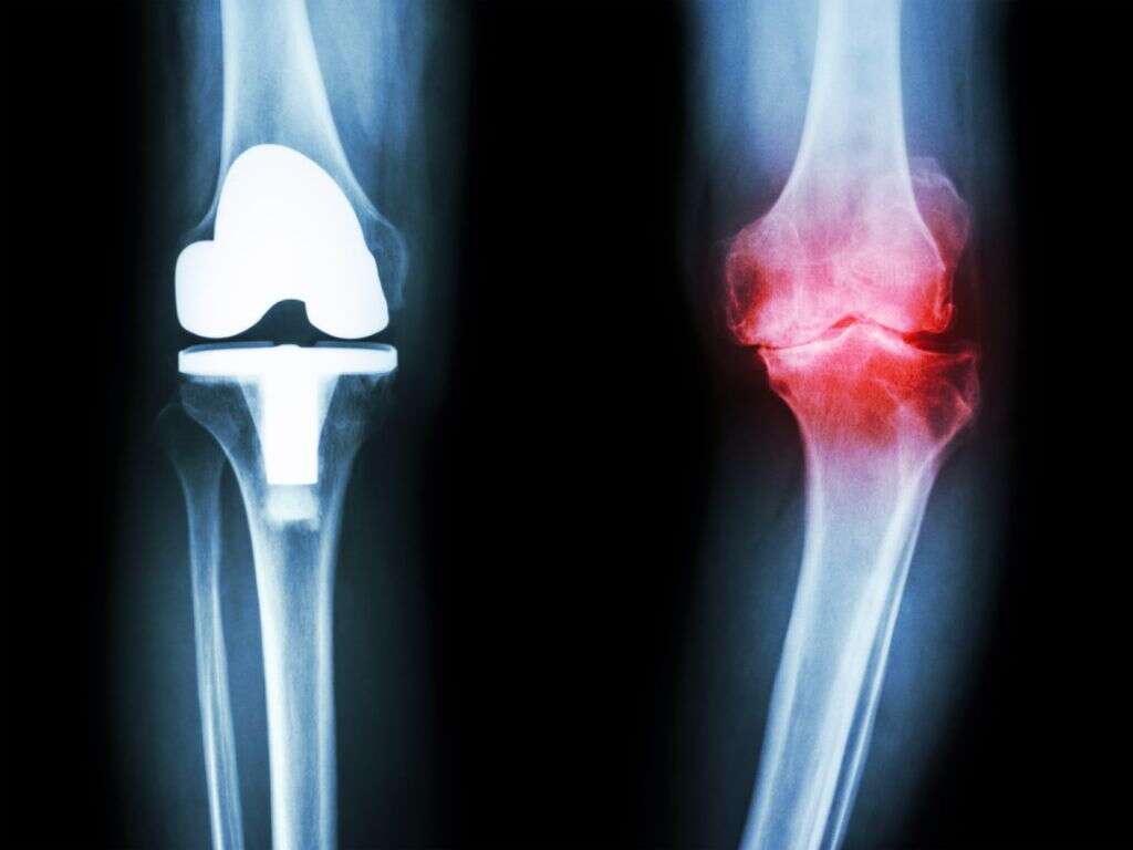 Nerve Compression Syndrome